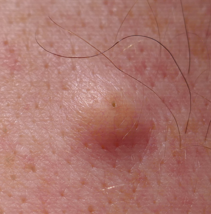 Atherom mit verstopfter Pore