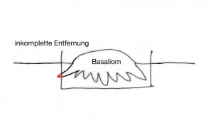 Das Basaliom ist an der linken Seite nicht vollständig entfernt, da es dort einen asymmetrischen Ausläufer aufweist.