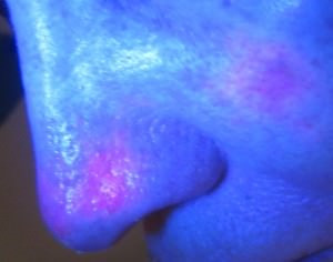 Aktinische Keratosen an der Nase und der Wange, sichtbar gemacht mit photodynamischer Diagnostik