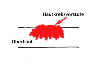 Hautkrebsvorstufen und oberflächliche Basaliome befallen die Oberhaut