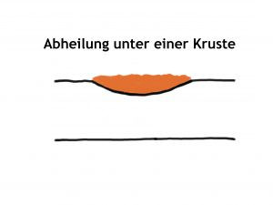 Die Behandlung führt zu einer Krustenbildung. Meist heilt die Wunde in 10-14 Tagen ab.