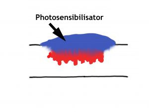 Konventionelle PDT (photodynamische Therapie): Der Wirkstoff diffundiert von oben in den Tumor