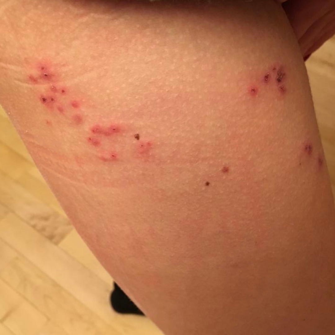 Herpes zoster nach Corona Impfung