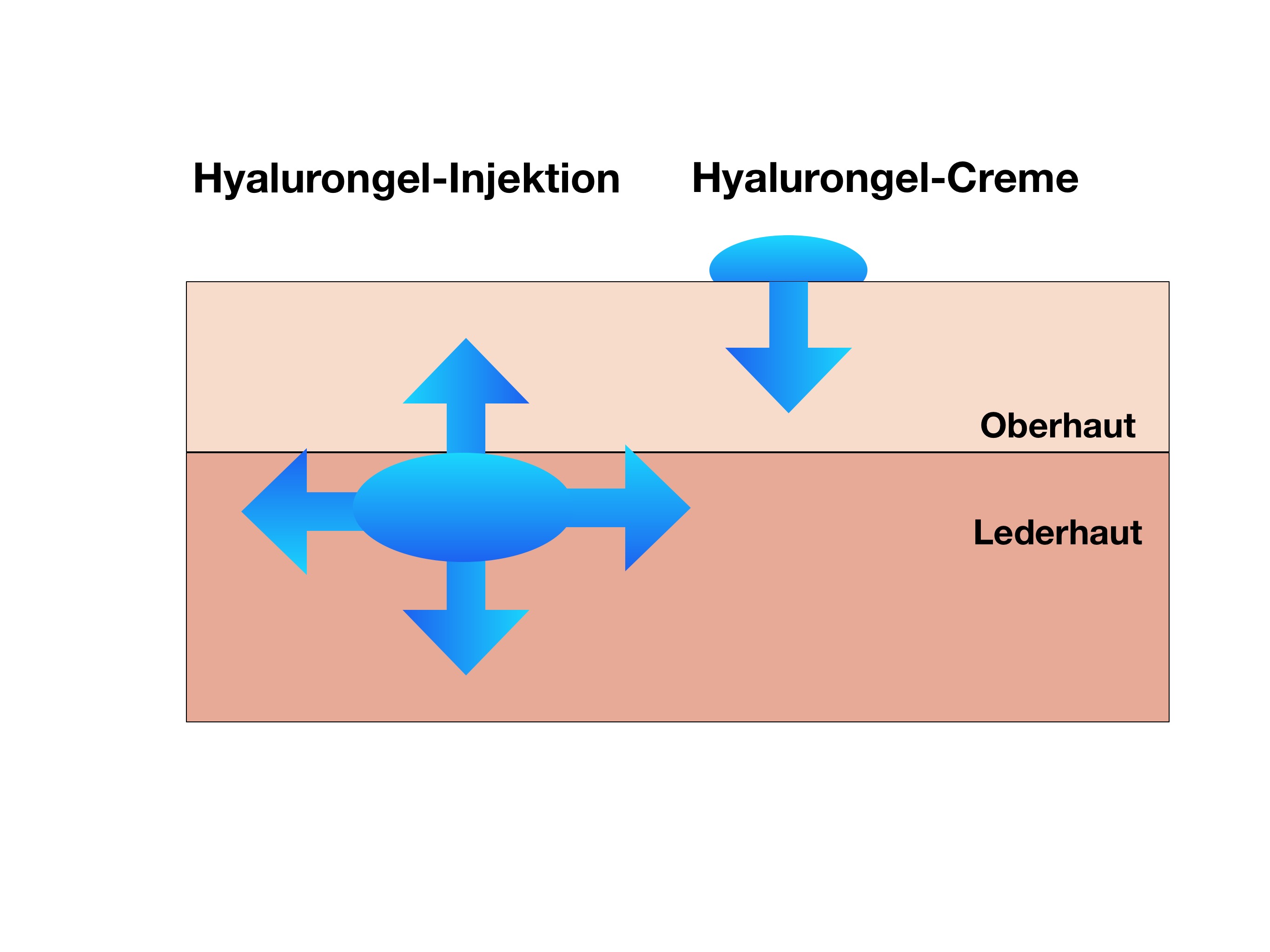 Hyaluron-Creme vs. Hyaluronunterspritzung