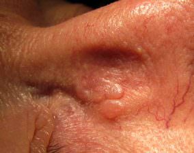 Basaliom an der Nasenseite Basaliom an der Nasenseite