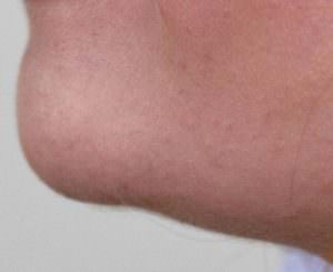 Belkyra löst das Fett des Doppelkinns auf Belkyra löst das Fett des Doppelkinns auf