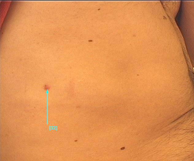 Rotes Hautmal an der Flanke rechts Rotes Hautmal an der Flanke rechts