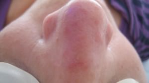 Aktinische Keratose am Nasenrücken Aktinische Keratose am Nasenrücken