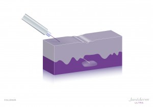 Faltenunterspritzung mit Hyaluronsäure in Mainz Faltenunterspritzung mit Hyaluronsäure in Mainz