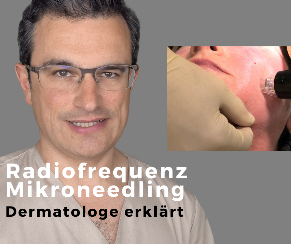 Radiofrequenz Mikroneedling Radiofrequenz Mikroneedling