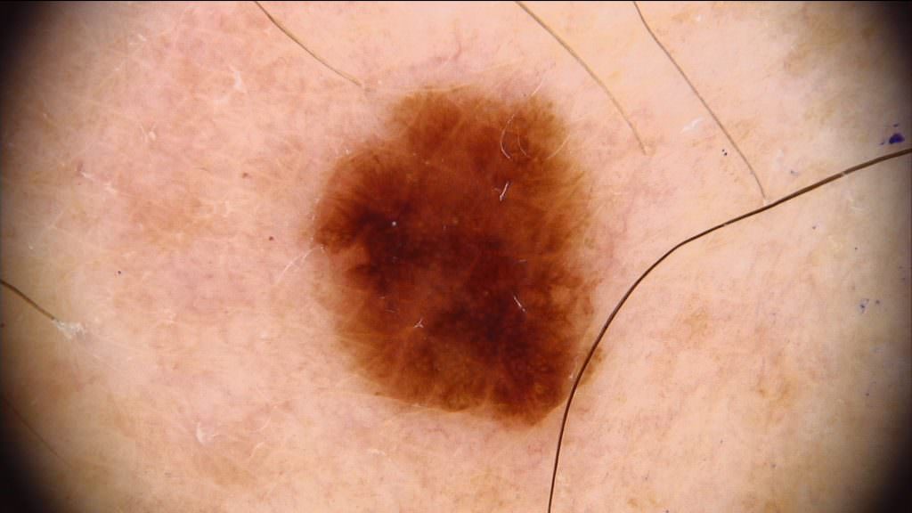 Bei der Hautärztlichen Untersuchung in Mainz fiel dieses Melanom auf Bei der Hautärztlichen Untersuchung in Mainz fiel dieses Melanom auf