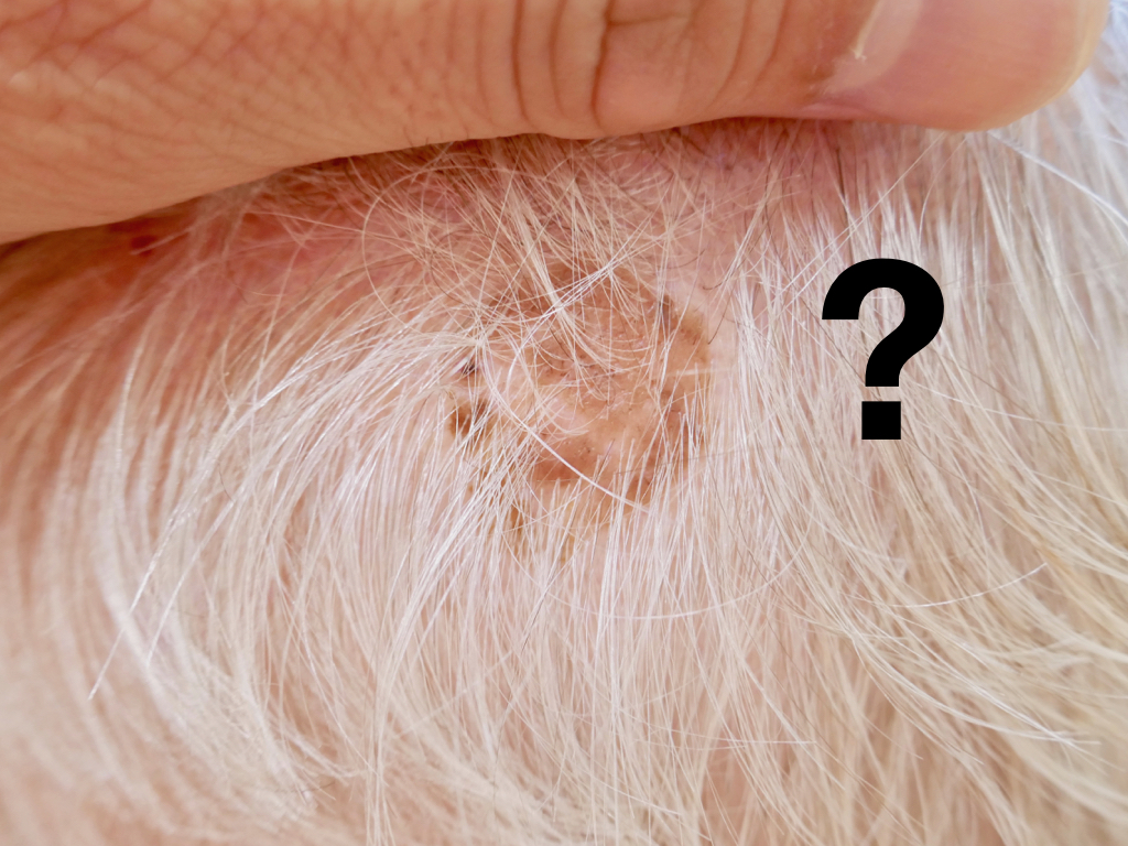 Melanom am Kopf Melanom am Kopf