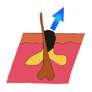 Mit der Hydrafacial-Behandlung werden Mitesser entfernt Mit der Hydrafacial-Behandlung werden Mitesser entfernt