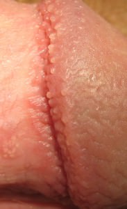 Pearly penile papules: Small flesh colored bumps on the corona orridges of the glans Pearly penile papules: Small flesh colored bumps on the corona orridges of the glans