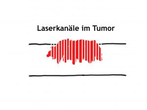 In den Tumor werden mit dem fraktionierten Laser Kanäle geschaffen In den Tumor werden mit dem fraktionierten Laser Kanäle geschaffen