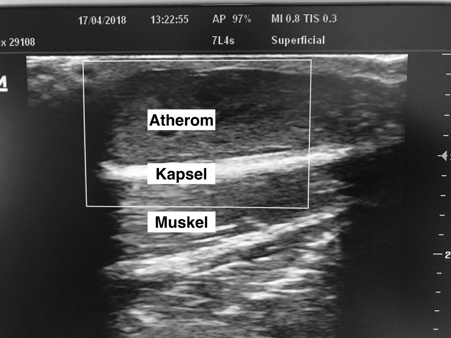 Ultraschallbild eines Atheroms