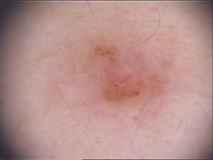 Bei der feingeweblichen Untersuchung fand sich ein Basalzellkarzinom Bei der feingeweblichen Untersuchung fand sich ein Basalzellkarzinom