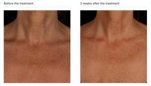 Bessere Hautqualität im Decollte nach einer Behandlung mit Juvederm Volite Bessere Hautqualität im Decollte nach einer Behandlung mit Juvederm Volite