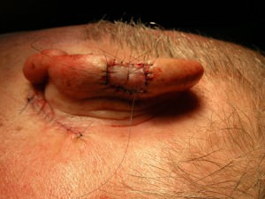 Die Haut wurde hinter dem Ohr entnommen und an Ohrmuschelrand mit Nähten befestigt Die Haut wurde hinter dem Ohr entnommen und an Ohrmuschelrand mit Nähten befestigt