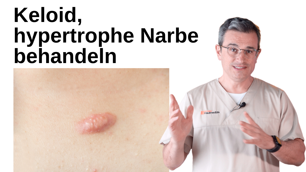 Keloide entfernen