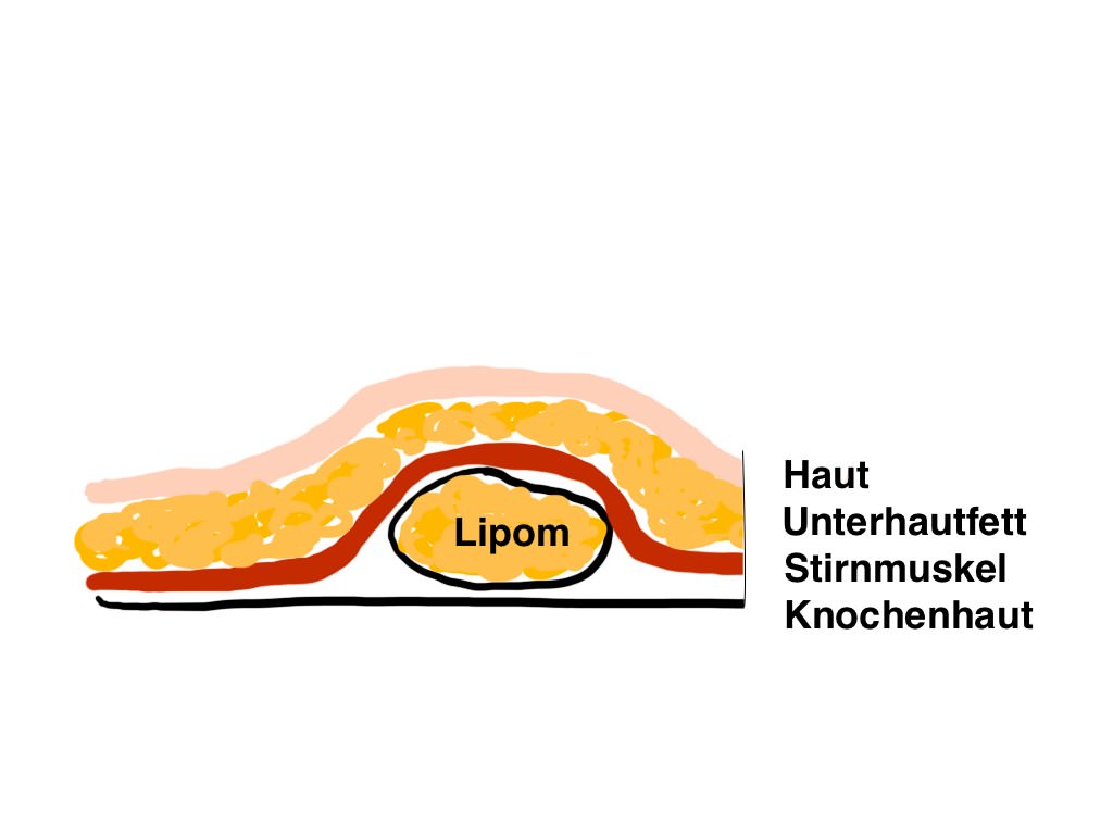Lipome an der Stirn liegen meist unter dem Stirnmuskel