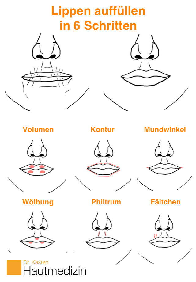 Natürlich schöne Lippen, statt Lippen aufspritzen