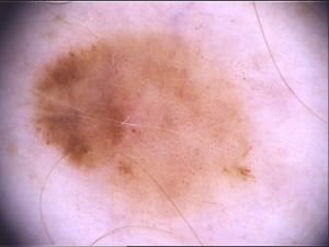 Melanom Symptome: Asymmetrie, unregelmäßige Begrenzung, unterschiedliche Farben, und größer als 5 mm