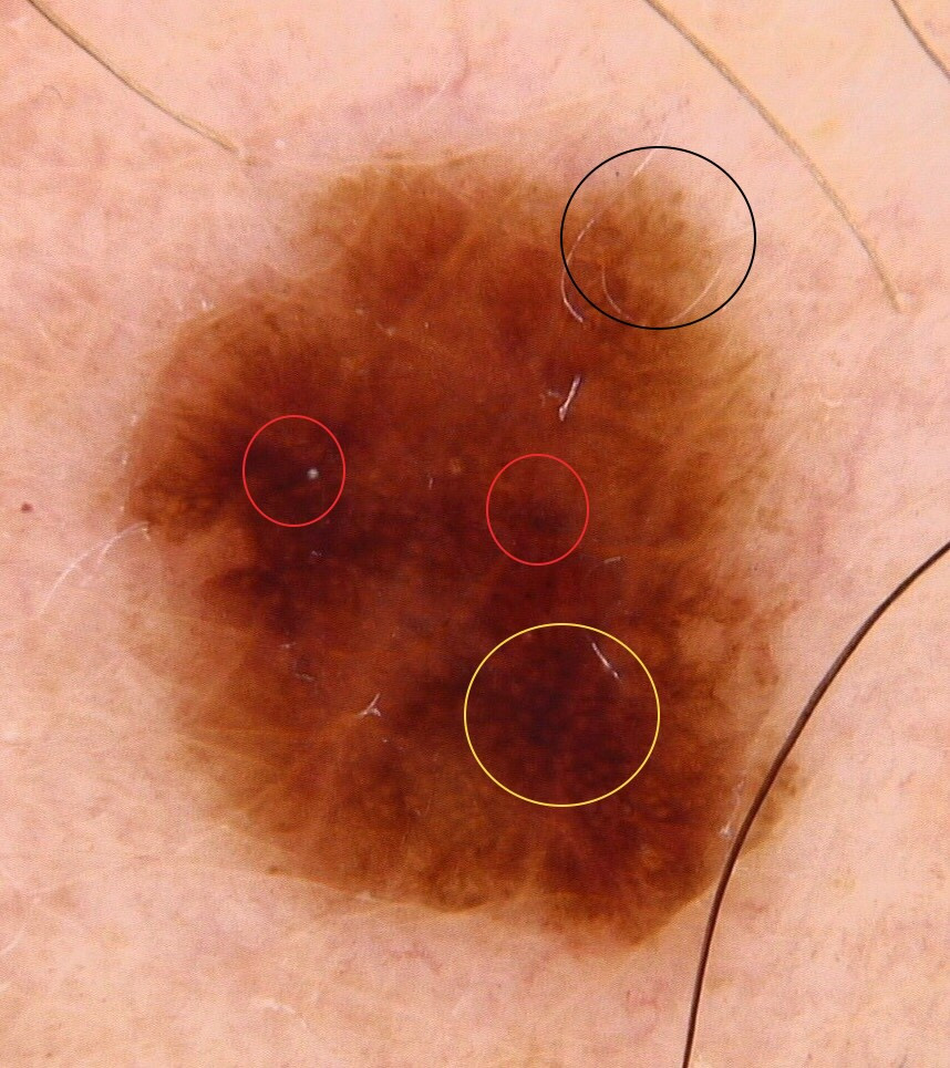 Melanomzeichen : unregelmäßige Streifen, unregelmäßiges Pigmentnetz und Flecken
