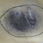 Minor Schweisstest in der Achsel