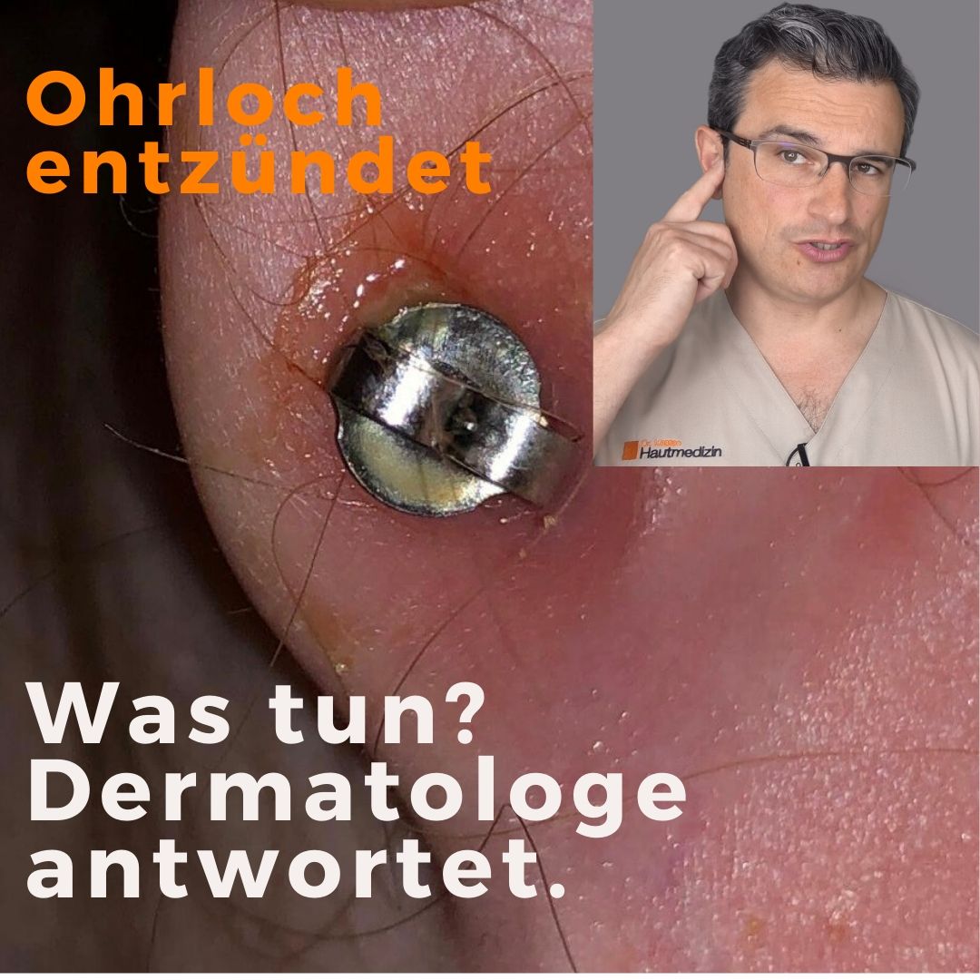 Ohrloch entzündet. Was tun?
