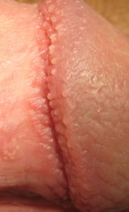 Pearly penile papules: Small flesh colored bumps on the corona orridges of the glans