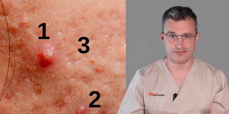 rote Pickelmale führen zu Aknenarben