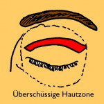 Schlupflid Entfernung