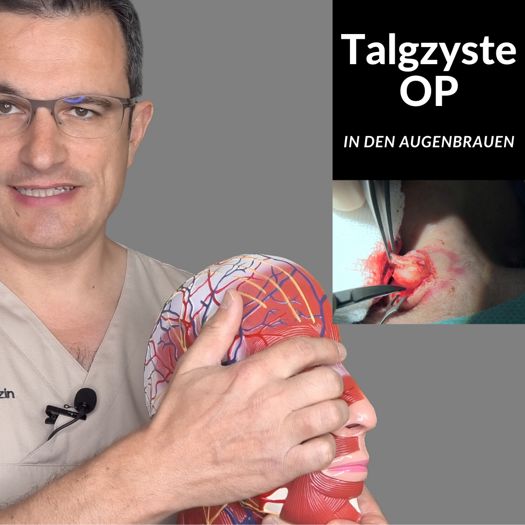Talgzyste in den Augenbrauen entfernen