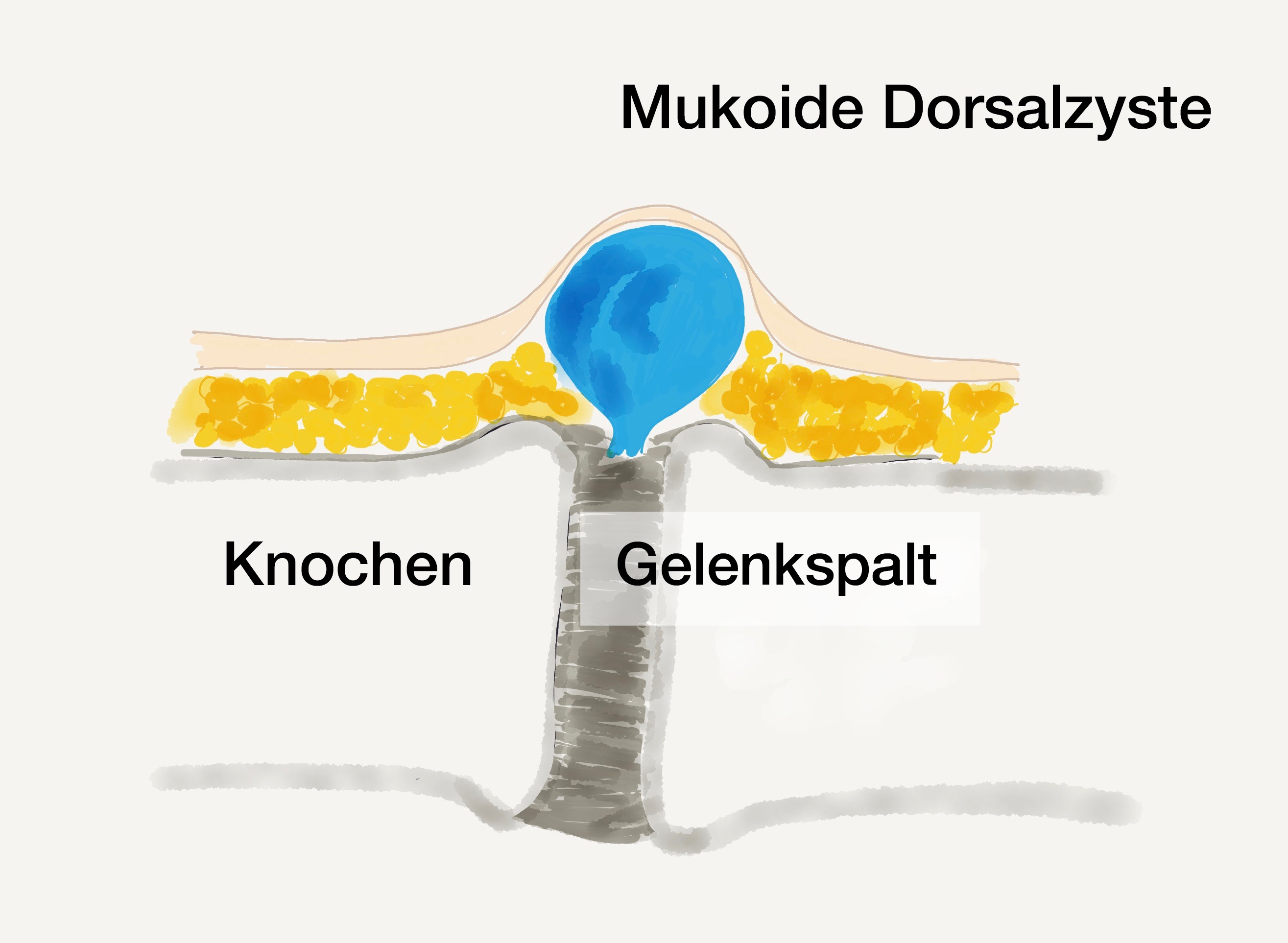 Mukoide Dorsalzyste