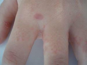 Swimmer´s Itch. Juckende kleine Hauterhebungen (Papeln) in den Fingerzwischenräumen