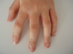 Zerkariendermatitis, swimmer´s itch der Finger