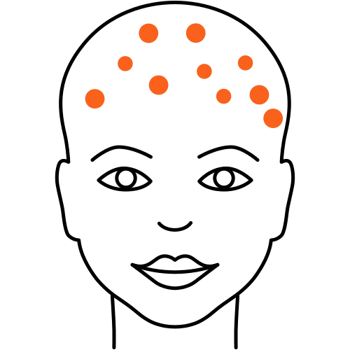 Aktinische Keratose Aktinische Keratose