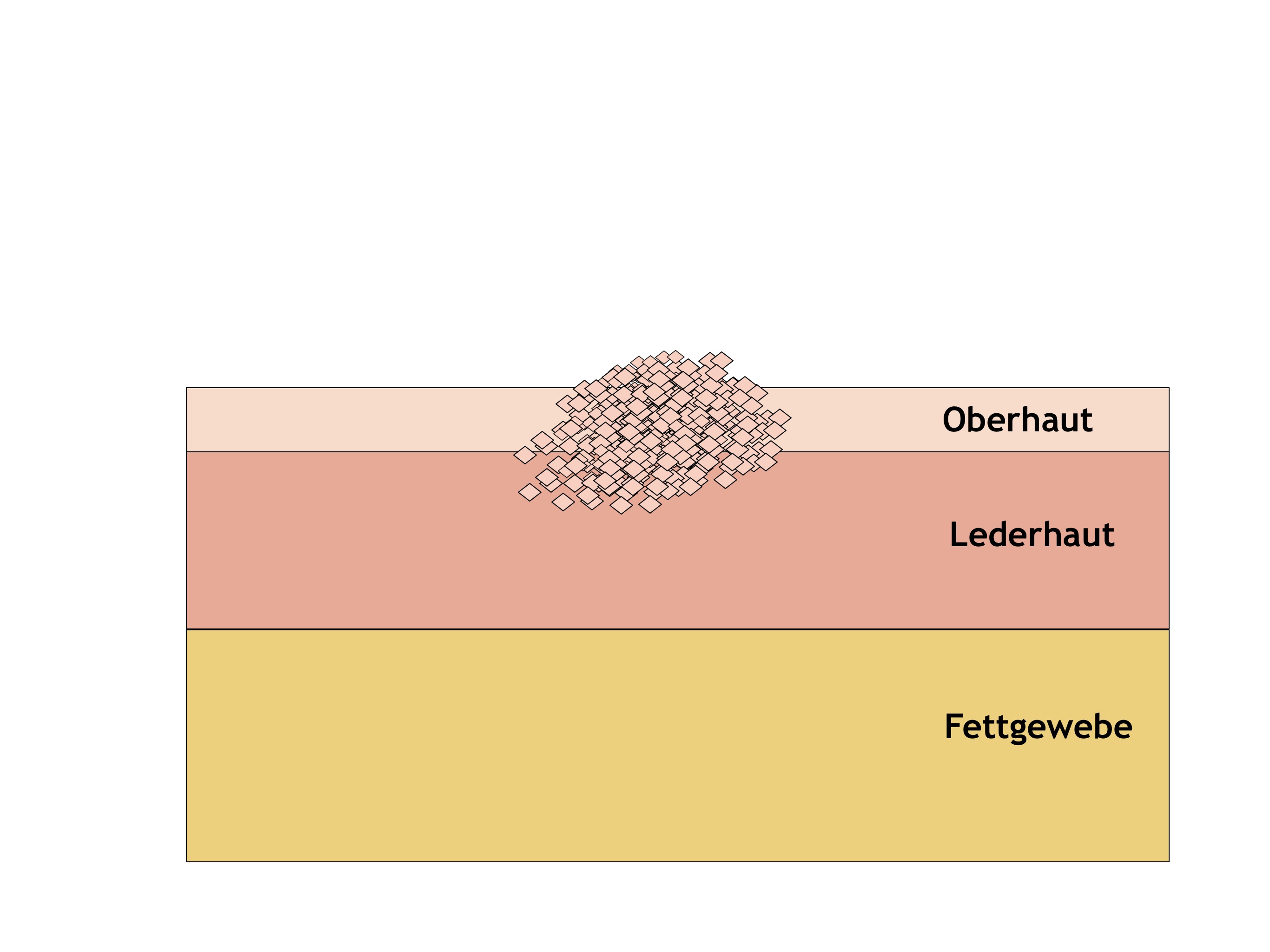 Spinaliom - Plattenepithelkarzinom der Haut