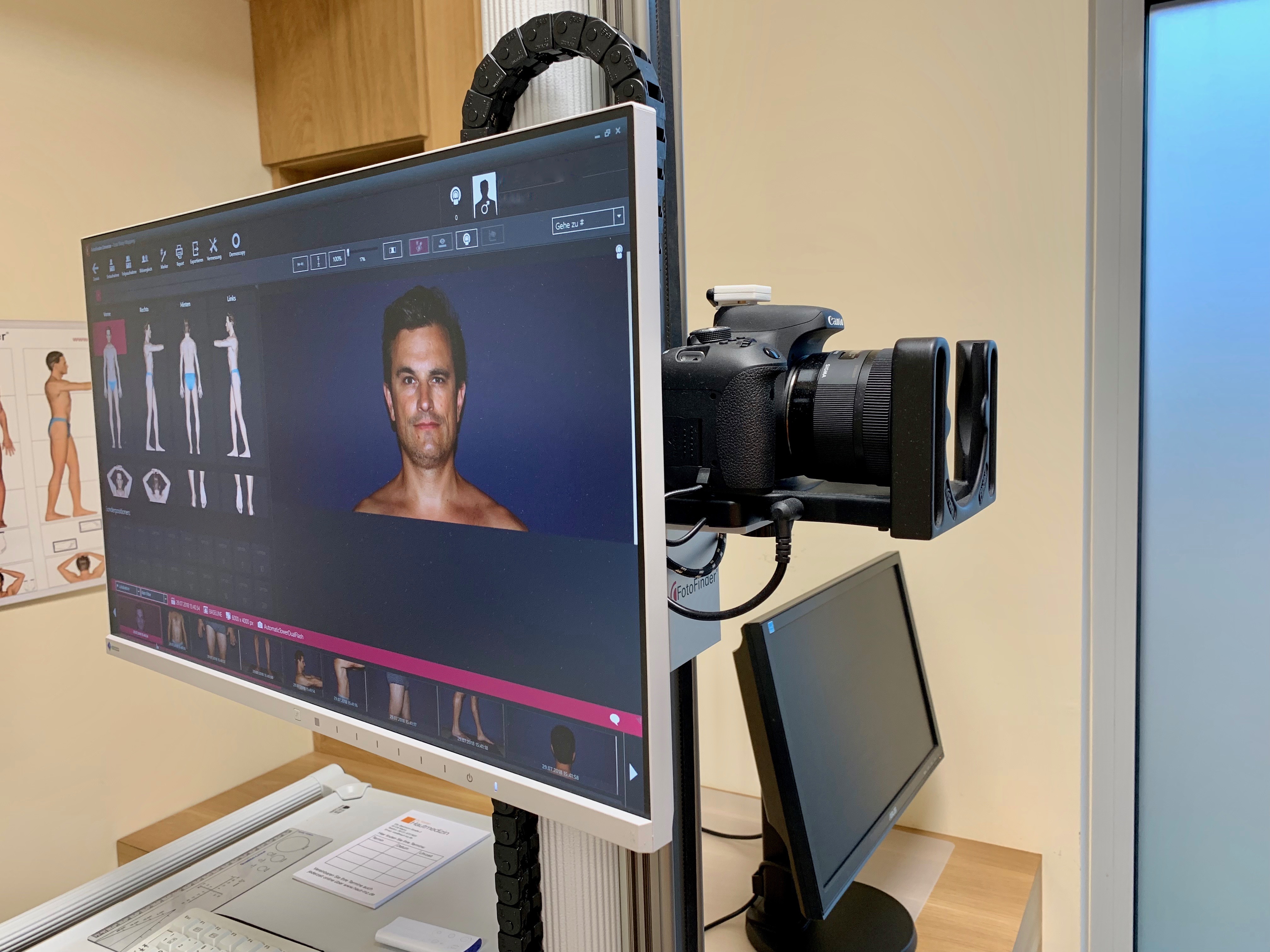 Fotofinder, Automatisches Totales Bodymapping