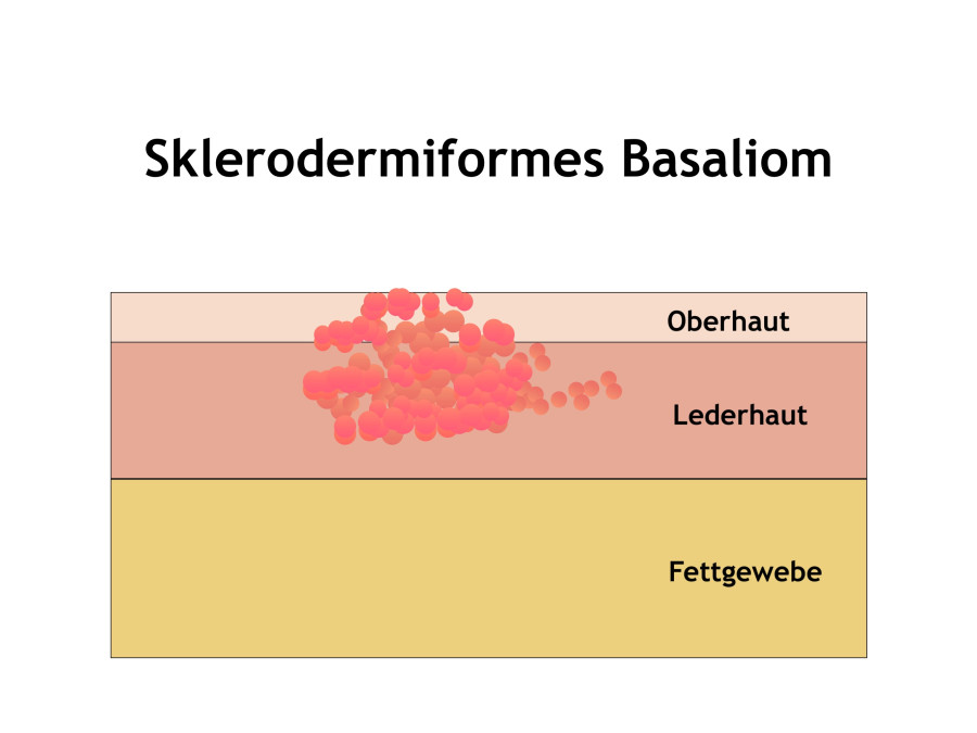 Hautarztpraxis Dr. Kasten, Mainz: Ein Sklerodermiformes Basalzellkarzinom 
