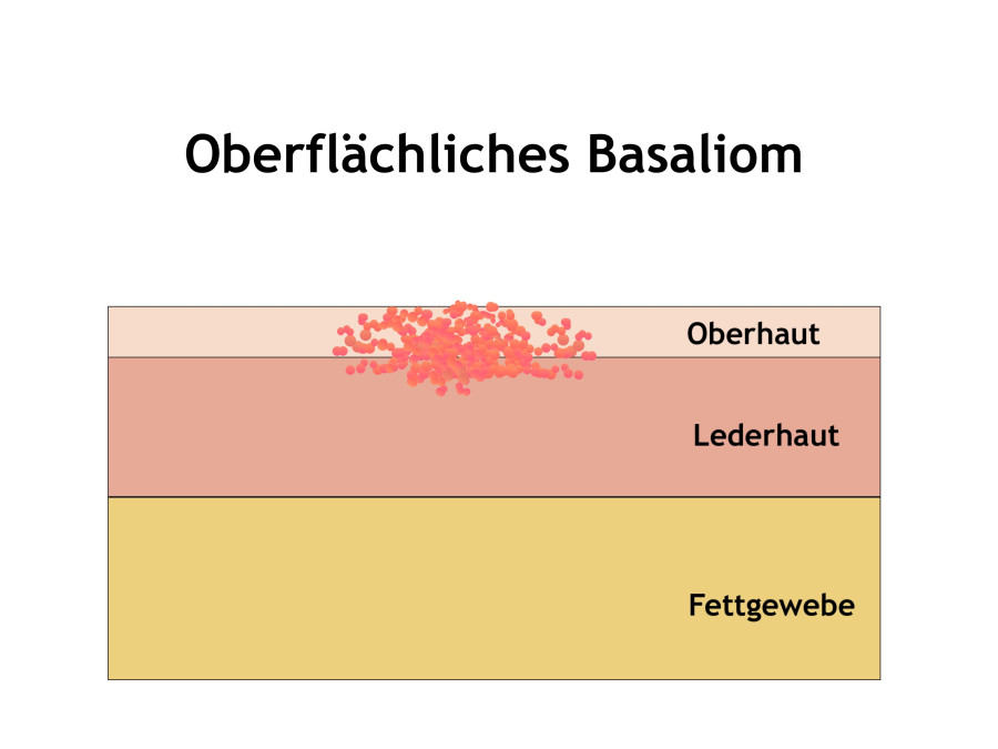 Oberflächliches Basalzellkarzinom in Mainz behandeln
