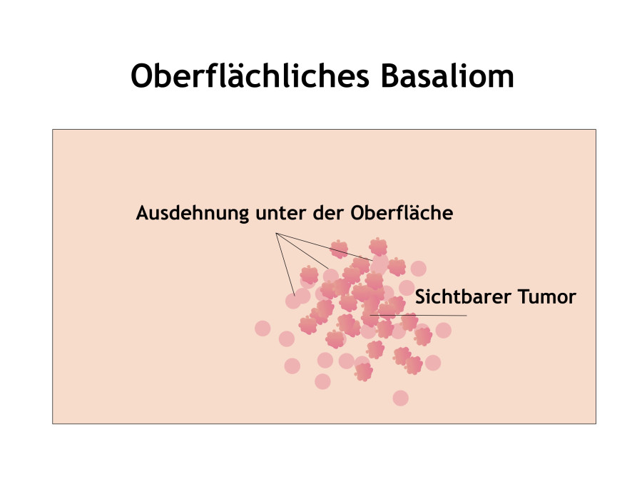 Oberflächliches Basaliom in Mainz behandeln