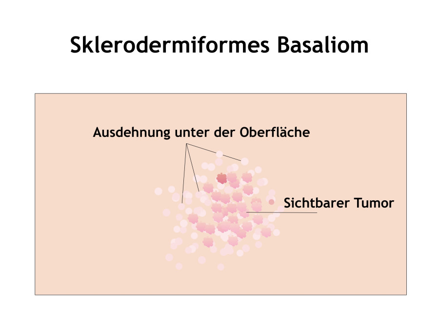 Sklerodermiformes Basaliom Mainz