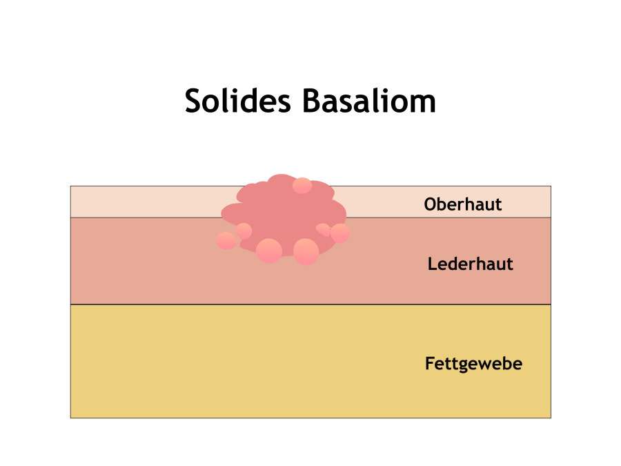 Solides Basaliom behandeln in Mainz