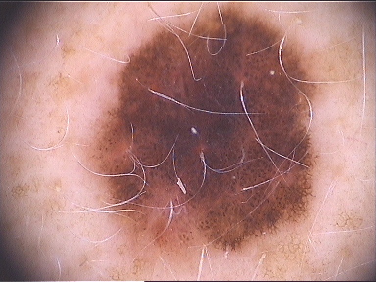 Dysplastischer Nävus Dysplastischer Nävus