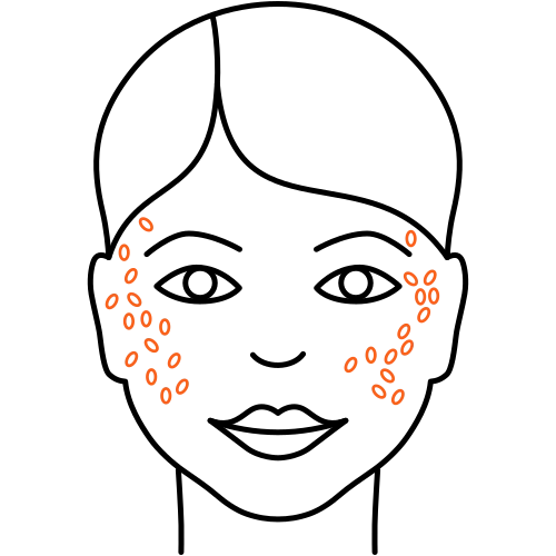 Aknenarben (Heilende Medizin) Aknenarben (Heilende Medizin)