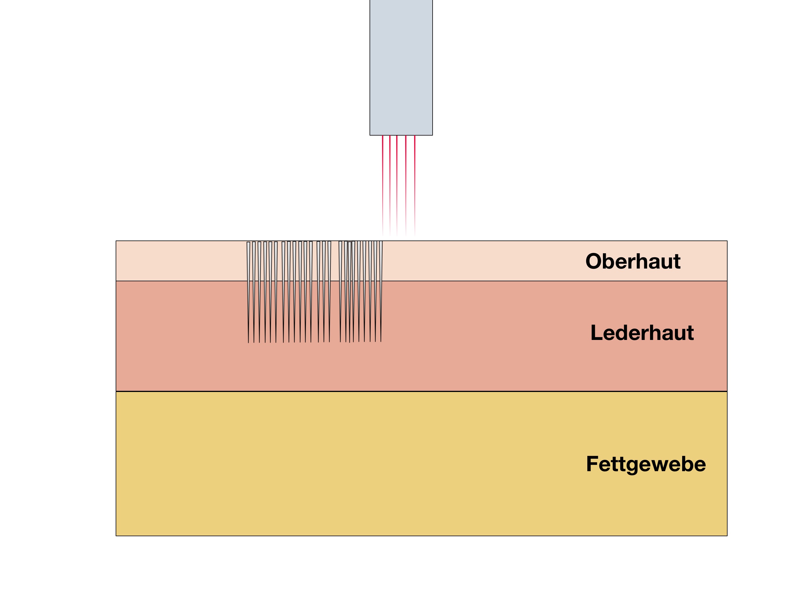 Fraktionierte CO2 Laser Behandlung