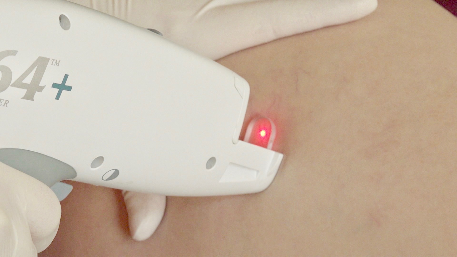 Laserbehandlung von Venen