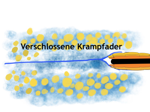 Krampfader Radiowellen